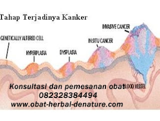 obat kanker herbal,obat kanker stadium 3,obat kanker stadium akhir,obat kanker payudara,obat kanker serviks,obat kanker otak,obat gejala kanker,cara mengobati kanker tanpa kemoterapi