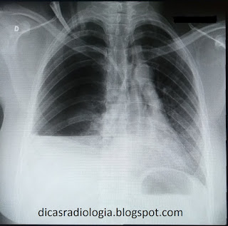 Raio x do torax mostrando derrame pleural - rx do torax