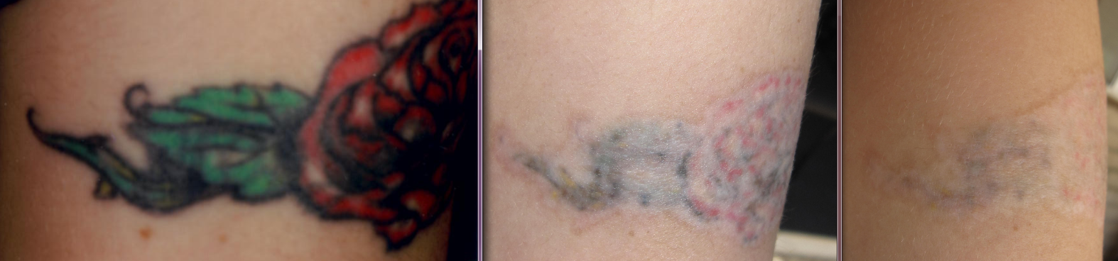 June+2011+Pre-Laser+Tattoo+Removal+-+After+6+Treatments+-+After+10 ...