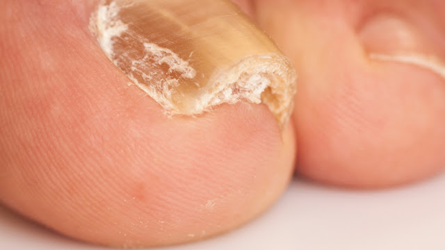 onychomycosis