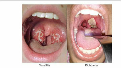 Difteri dan Cara Mencegah Penyakit Difteri 