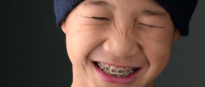  Niềng răng có ảnh hưởng gì không?