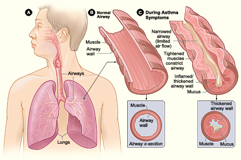 Bronchial Asthma Diagnosis and Treatment