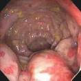 Causes of  Appendicitis