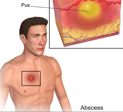 Laboratory diagnosis of skin and soft tissue infections