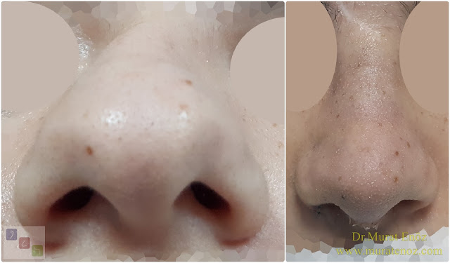 Treatment of Twisted Nose  - Treatment of Crooked Nose - Crooked Nose Aesthetic Surgery in Istanbul - Twisted Nose Treatment in Istanbul - Female Nose Aesthetic Surgery - Nose Jobs For Women - Nose Reshaping for Women - Female Rhinoplasty Istanbul - Nose Job Surgery for Women - Women's Rhinoplasty - Nose Aesthetic Surgery For Women - Female Rhinoplasty Surgery in Istanbul - Female Rhinoplasty Surgery in Turkey - C Burun - Crooked Nose - Deviated Nose - Twisted Nose - Deflected Nose - Asymmetric Nose - Scoliotic Nose - Rhinoplasty in Istanbul - Rhinoplasty Istanbul - Rhinoplasty in Turkey - Rhinoplasty Turkey - Nose Job Istanbul - Nose Job Turkey - Challenges in Treatment of Deviated Nose