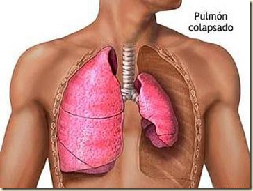 Cancer Pulmonar II