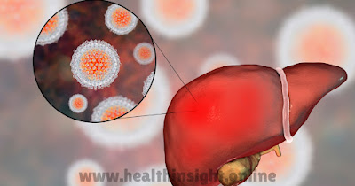 Common Liver Conditions And Their Impact