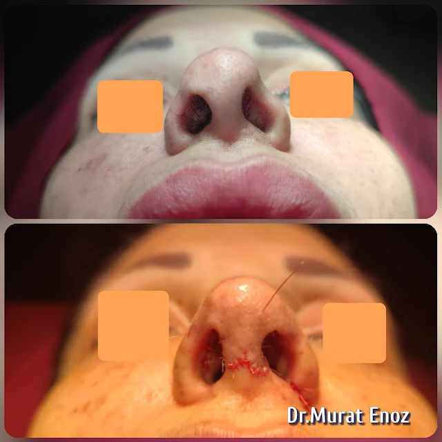 Complicated 3rd Revision Nose Aesthetic,tertiary revision nose aesthetic surgery,Tertiary revision nose job in Istanbul,