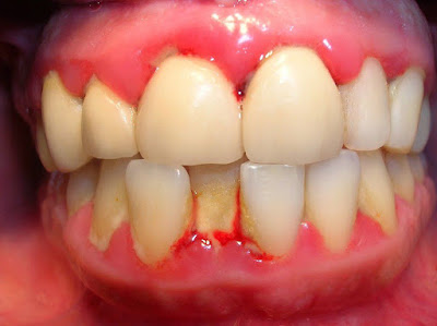 Vì sao chảy máu răng khi đánh răng?