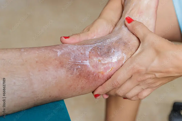 Home care for leg wounds