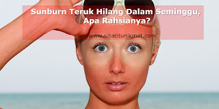 cara merawat sunburn