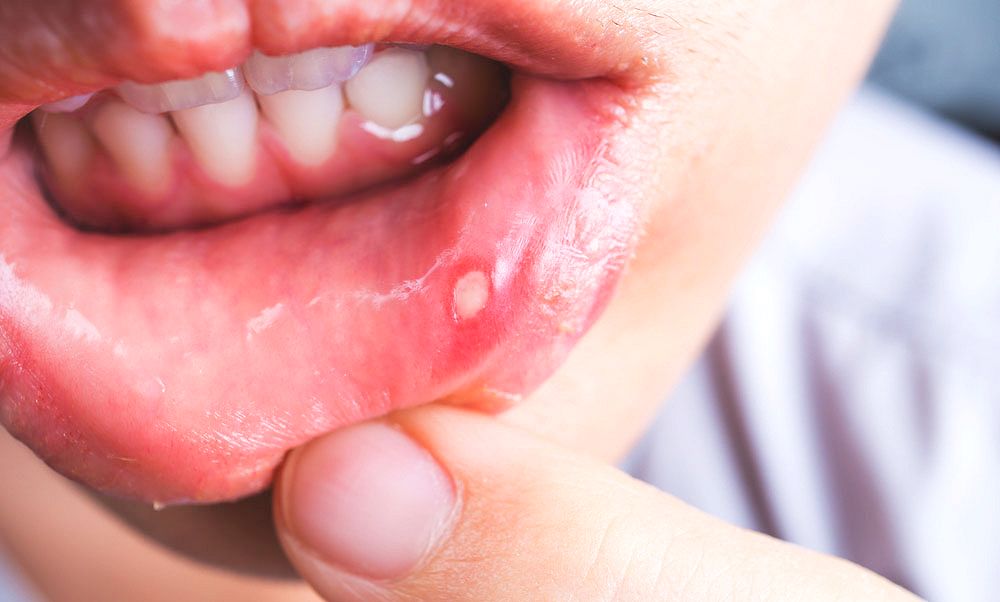 Mouth Ulcers