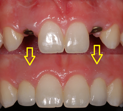 So sánh răng implant với cầu răng sứ