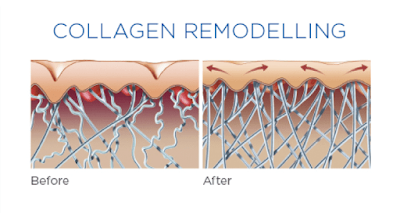 how iastm works