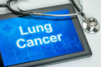 Where did Lung Cancer Originate