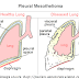 Why Asbestos and Mesothelioma Cancer Should Be Spoken in the Same Sentence