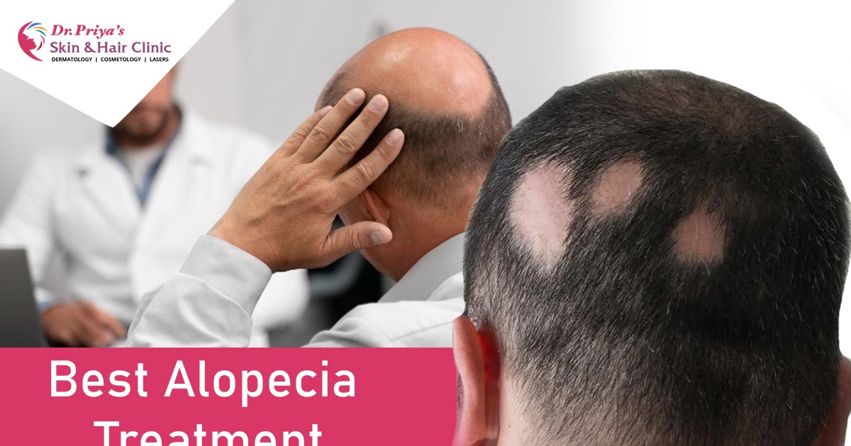 Signs That Tell You Need an Alopecia Treatment