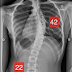脊椎側彎矯正案例27-胸椎側彎42度~31度