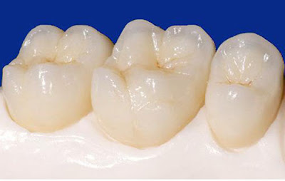 Kỹ thuật trám răng duy trì được bao lâu?-1