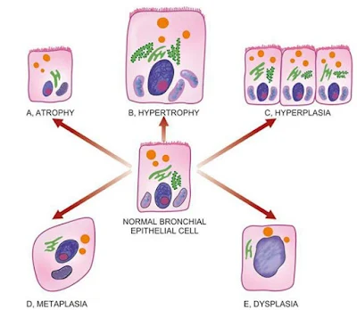 cellular adaptation, pathology