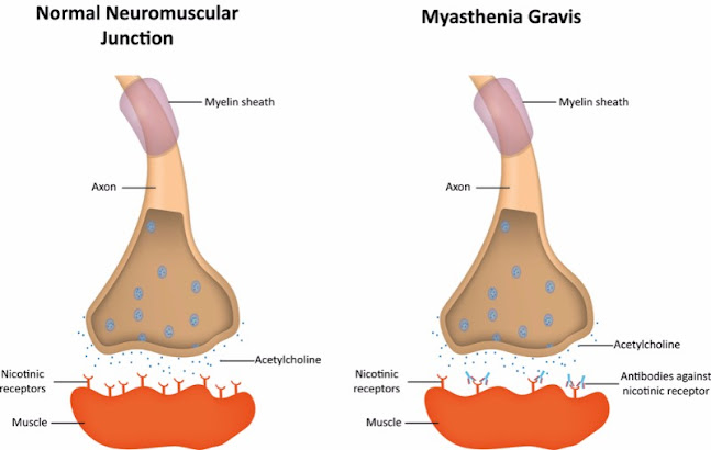 Myasthenia Gravis Treatment