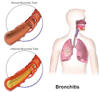 Askep Bronkitis Lengkap batuk berdahak bronkitis pada anak