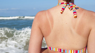 home-remedies-sunburn وصفات طبيعية لتلطيف البشرة المحترقة
