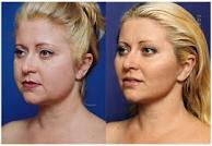 Face with lift surgery