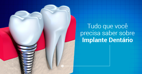  Ilustração de Implante Dentário