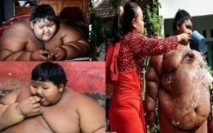 World's fattest child in Indonesia