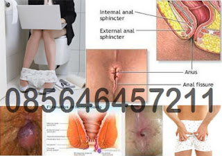 Cara Mengatasi Problem Hemorrhoids atau Wasir di Dubur