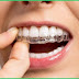 Phương pháp niềng răng không mắc cài 3D Clear 