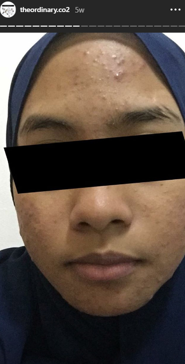 'Bertahun kulit muka teruk camni sebab salah skincare 