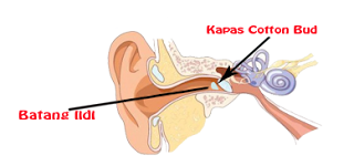 Ilustrasi cara mengeluarkan kapas cutton bud yang tertinggal didalam telinga
