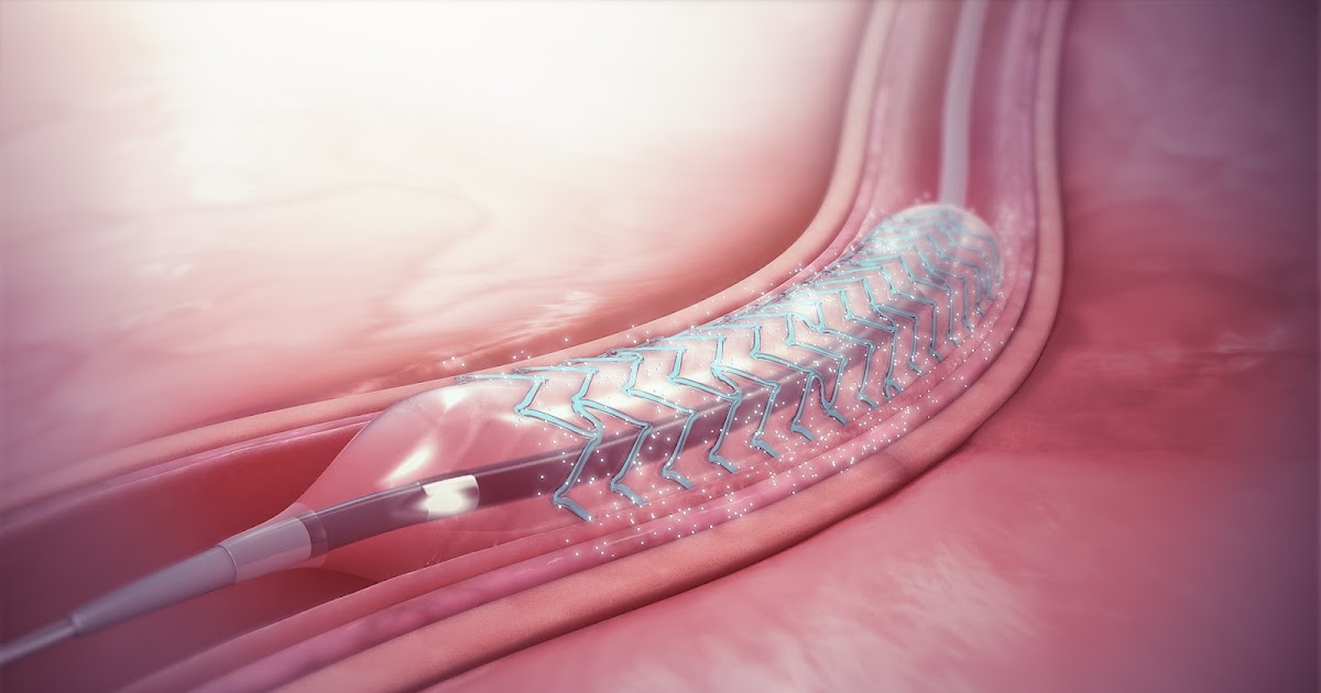 Global Drug Eluting Stents Market Industry Trends and Forecast to 2027