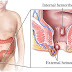 Nursing Care Plan for Hemorrhoids