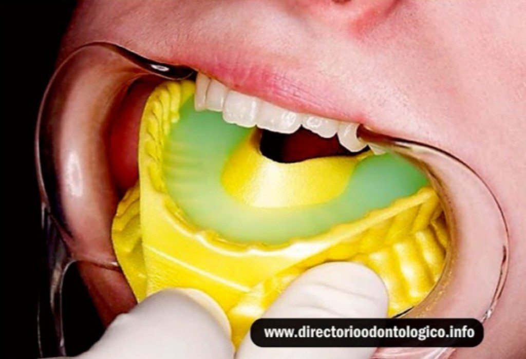 Fluor Dental Prevencion