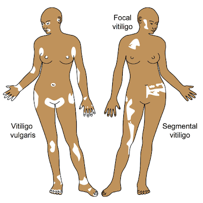 vitiligo patches