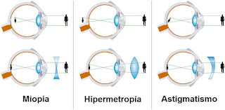 miopia hipermetropia astigmatismo