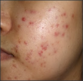 acne pimples