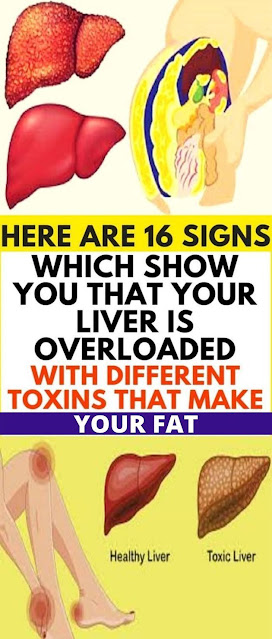 16 Signs Which Are Warning You That Your Liver Is Overloaded With Toxins That Make You Fat!