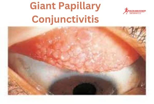 Giant Papillary Conjunctivitis