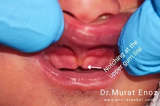 Lip tie nothcing