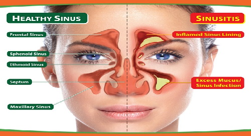 Cara Ubat Hidung Tersumbat - Kerja Kosk