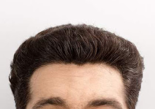 hair transplant in Islamabad