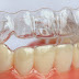 Niềng răng nhựa loại bỏ bất tiện niềng răng truyền thống
