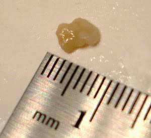 What's causing me to get tonsil stones