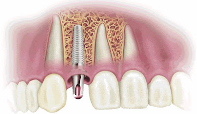 Trồng răng giả có đau không với implant? 1