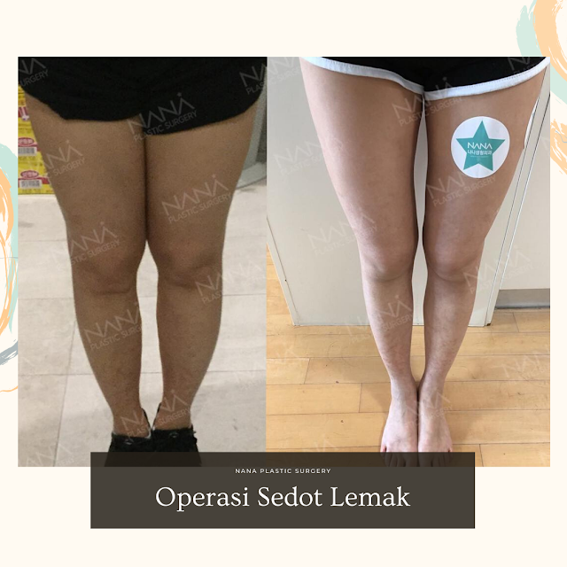 operasi sedot lemak, liposuction, sedot lemak badan, sedot lemak full, sedot lemak mini, badan gendut, lemak berlebih, lemak badan, sedot lemak badan, operasi plastik korea, bedah plastik, bedah plastik korea, klinik bedah plastik korea, klinik kecantikan